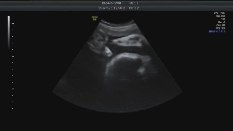 Ultrasound Face and Hands (7mo)