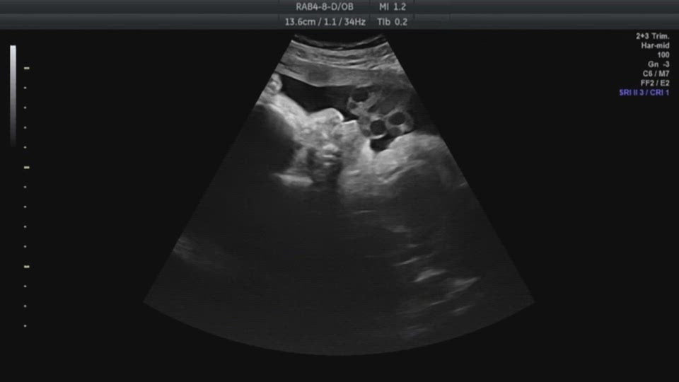 Ultrasound Heartbeat