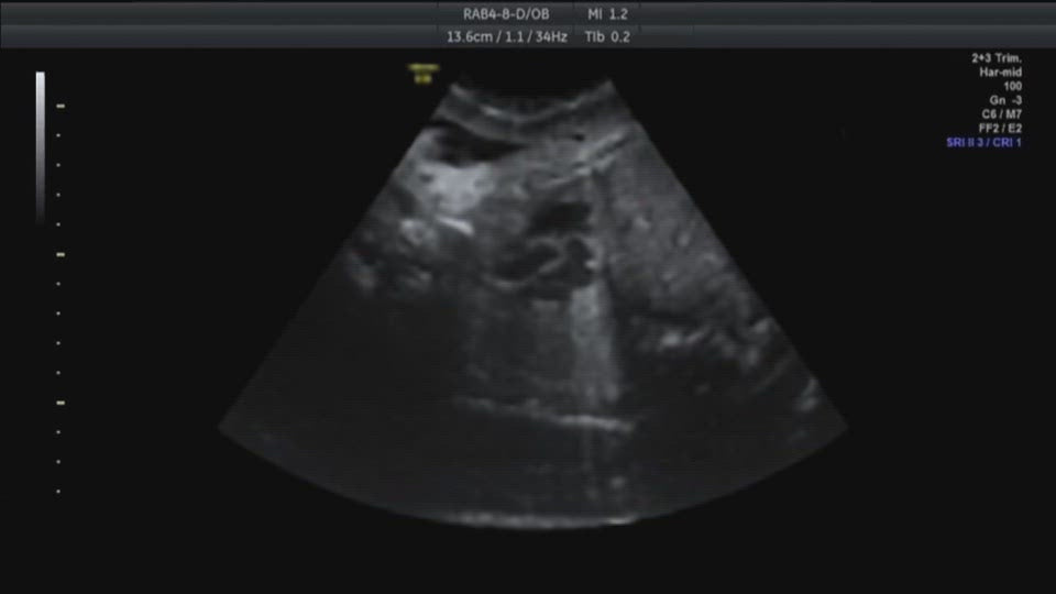Ultrasound HR Waveform