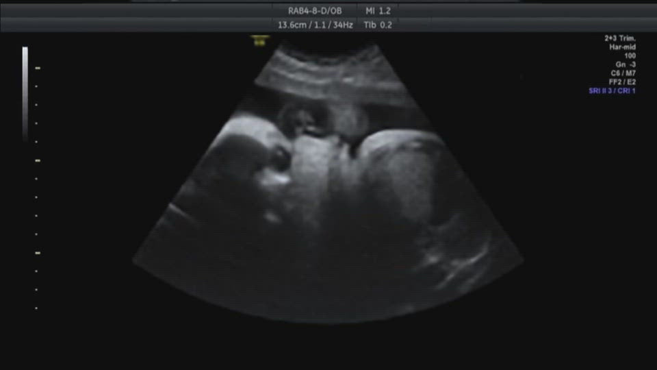 Ultrasound Blood Flow (7mo)