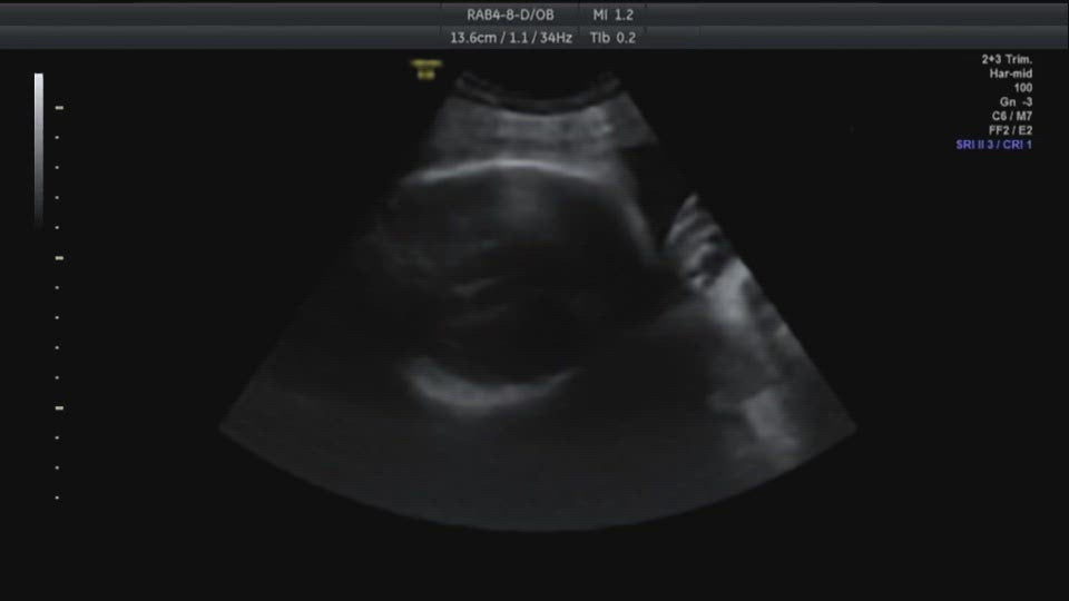 Ultrasound Baby Face (7mo)