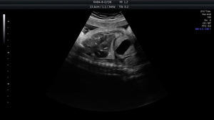 Ultrasound Heartbeat