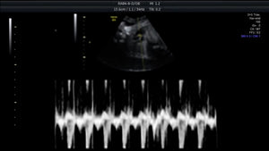 Ultrasound HR Waveform
