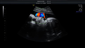 Ultrasound Blood Flow (7mo)