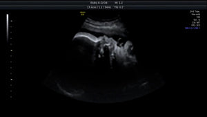 Ultrasound Baby Face (7mo)