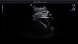 Ultrasound Baby Feet(7mo)